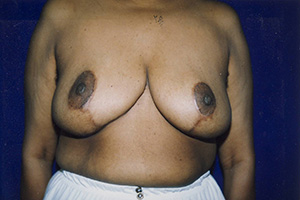 Breast Reduction 5b